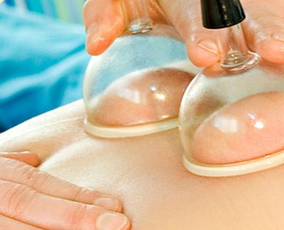 Hijama & Cupping